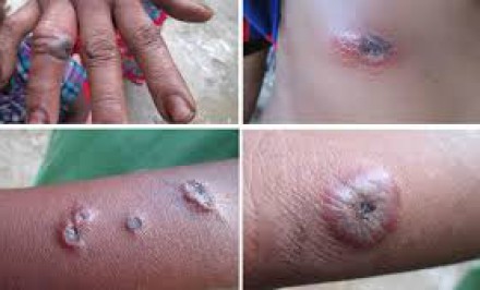 শাহজাদপুরে আবারো ১৩ অ্যানথ্রাক্স রোগী সনাক্তঃ এলাকায় আতংক